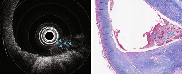 Ультратонкая волоконно-оптическая система может заглянуть внутрь кровеносных сосудов